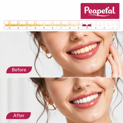 Professional Whitening System for Everyday Smile Confidence